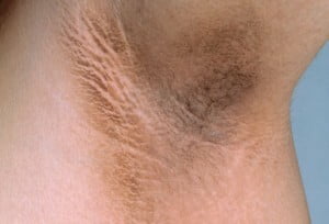 cara atasi ketiak hitam tinispa